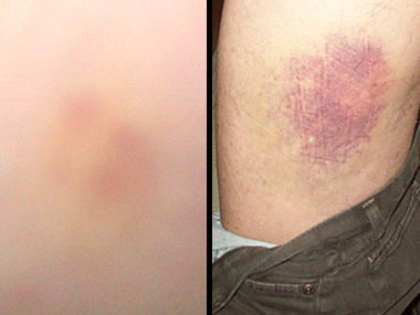 Strange bruises